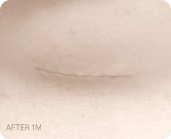 Ab Surgery