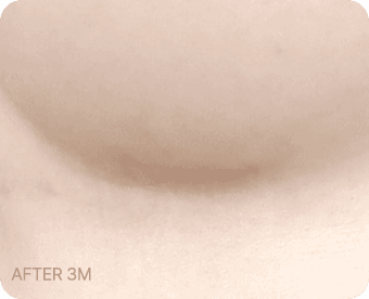 Ab Surgery