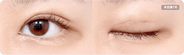 beforeAfter