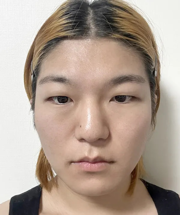 Before and after surgery front view