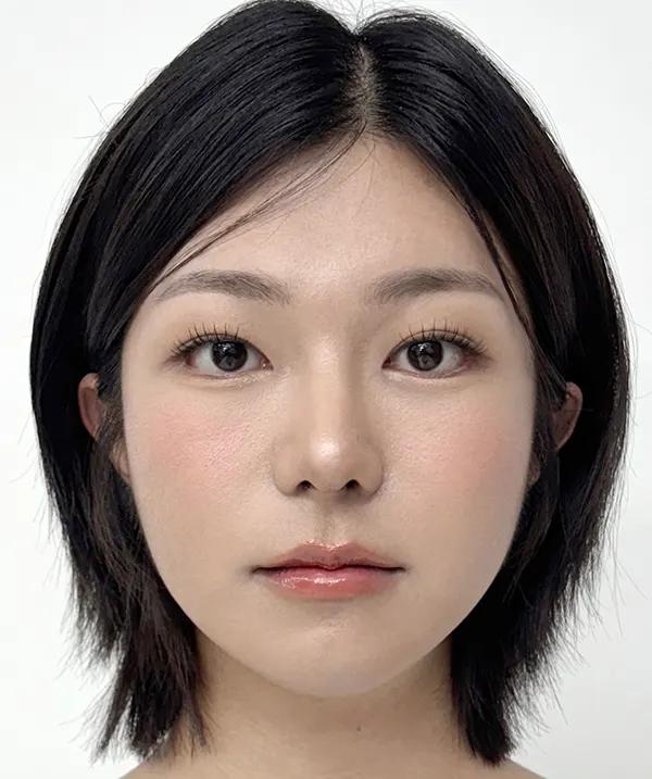 Before and after surgery front view