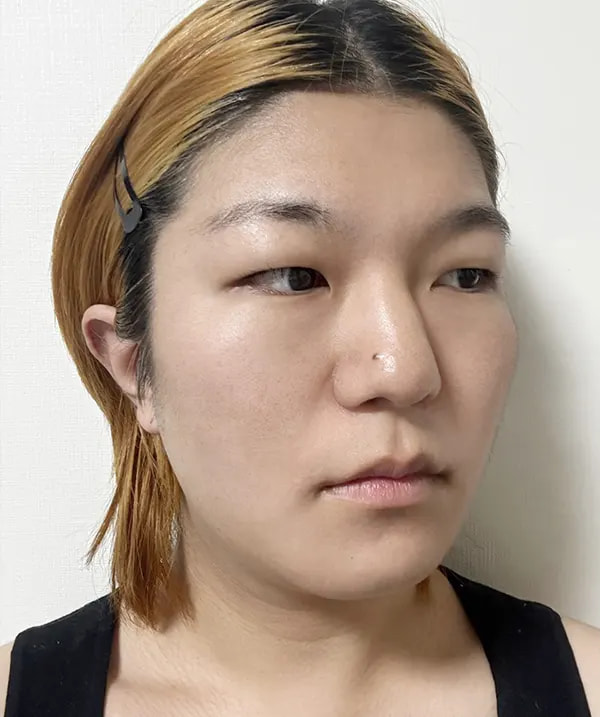 Before and after surgery side view