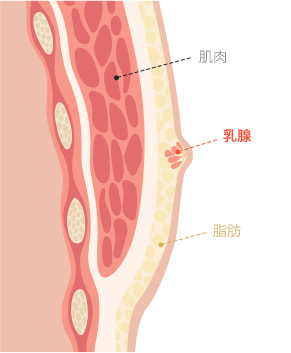 Gynecomastia surgery