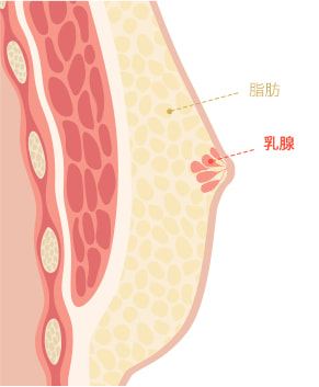 Gynecomastia surgery