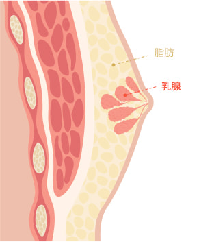 Gynecomastia surgery