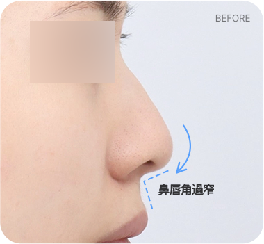 CASE 1. 鼻唇角過窄 before