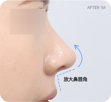CASE 1. 鼻唇角過窄 after