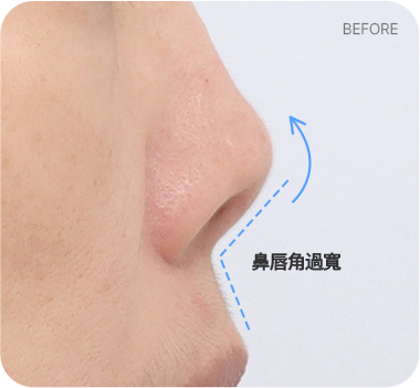 CASE 2. 鼻唇角過寬 before