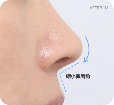CASE 2. 鼻唇角過寬 after