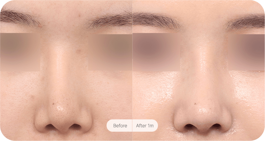 revision-rhinoplasty