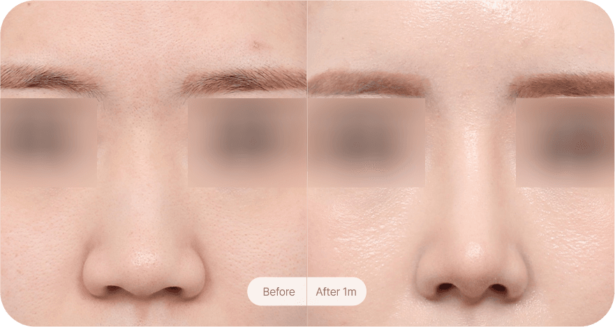 revision-rhinoplasty