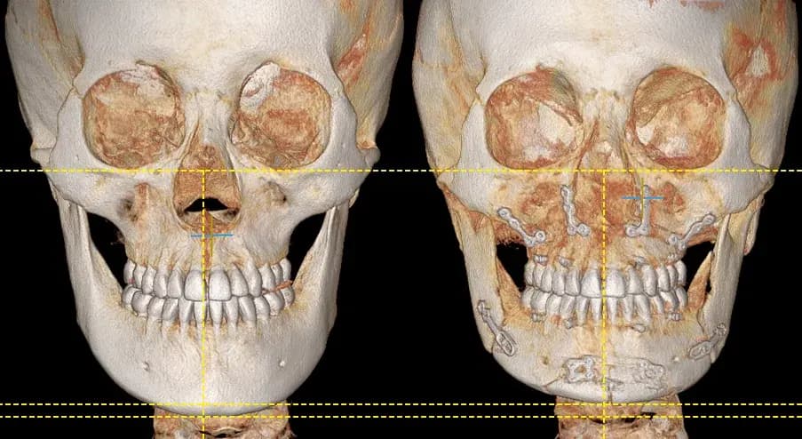 雙顎手術 3D-CT 術前術後