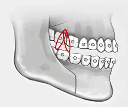 3. 简单橡皮筋固定,获得稳定的術後效果
