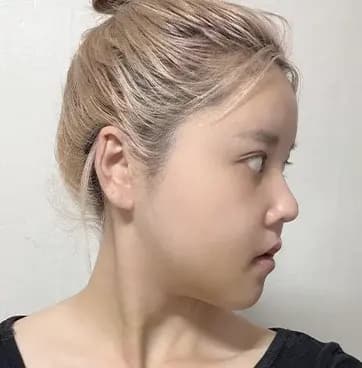 術後第12天