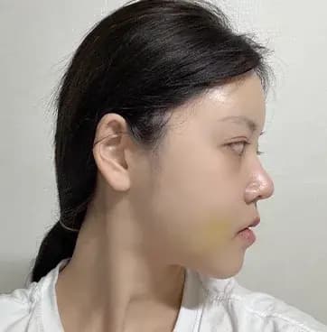 術後第14天