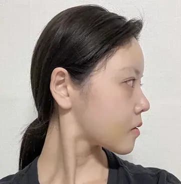 術後4周