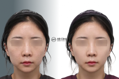 水光針真的適合你嗎?從膚質判斷到療程比較,一次看懂關鍵差異