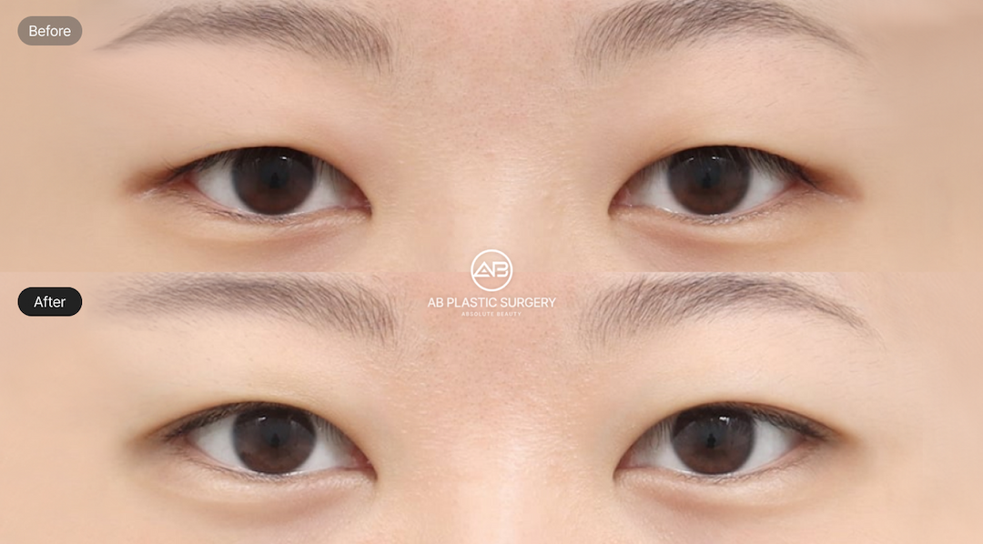 丹鳳眼是什麼眼型?特徵解析與韓式眼型設計調整全指南