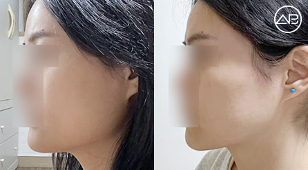 【下颌角缩小,咬肌缩小】 术后6个月【真实后记】