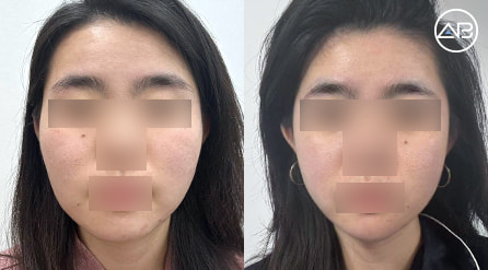 【轮廓三件套,面吸,双下巴】 术后7个月【真实后记】