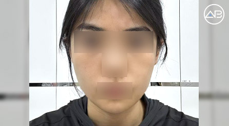 【轮廓三件套】 术后4个月【真实后记】