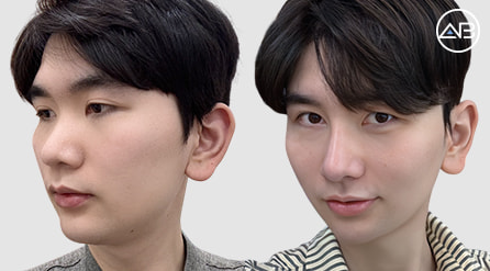 【鼻综合】 术后6个月 【真实后记】