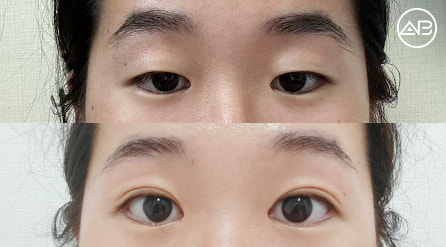 【開上眼角+切開法提肌雙眼皮】 術後6個月【真實後記】