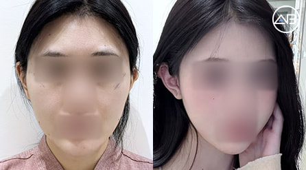 【顴骨內推+取頰脂墊+面部吸脂】 術後1個月【真實後記】