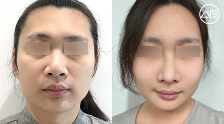 【雙眼皮+眼底脂肪重排+鼻綜合+補脂+輪廓三件套】 術後2個月【真實後記】
