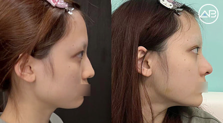 【埋線雙眼皮+開眼頭+額頭提升+鼻綜合】 術後5個月【真實後記】