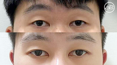 【切開法提肌雙眼皮+開眼頭+開後眼角+下至】 術後1個月【真實後記】