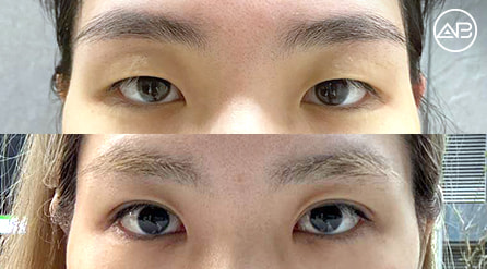 【埋線雙眼皮提肌+開眼頭】 術後2個月【真實後記】