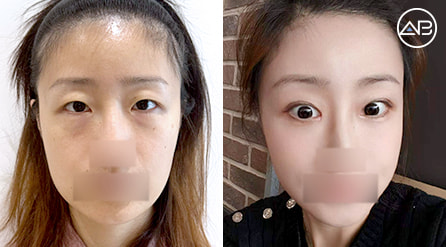 【埋線雙眼皮脂肪移植+開眼頭+提眉術+眼底脂肪重排+蘋果肌脂肪填充】 術後3個月【真實後記】
