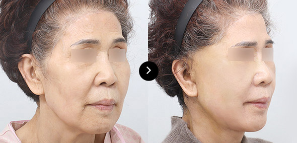 全臉SMAS提升 이미지 1