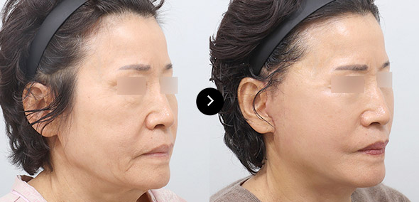 全臉SMAS提升 이미지 2
