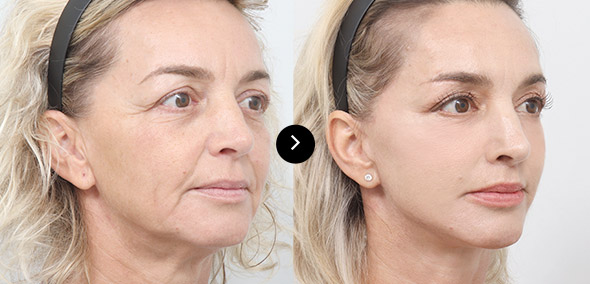 全臉SMAS提升 이미지 3