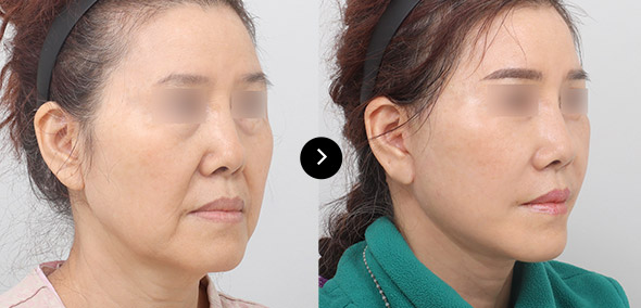 全臉SMAS提升 이미지 4