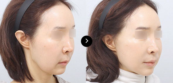 全臉SMAS提升 이미지 5