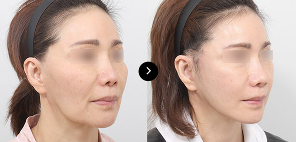 全臉SMAS提升 이미지 6
