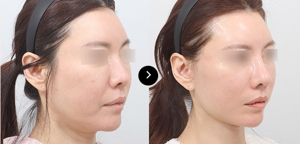 半臉SMAS提升 이미지 1