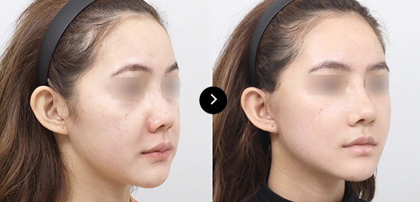 半臉SMAS提升 이미지 3