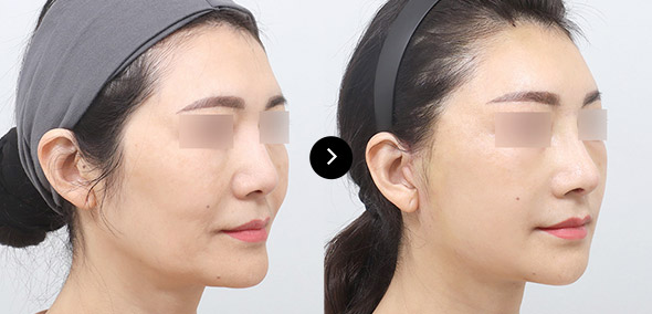 半臉SMAS提升 이미지 4