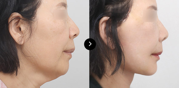 頸部提升 이미지 2