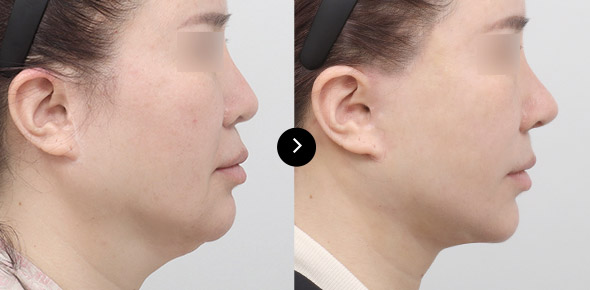 頸部提升 이미지 3