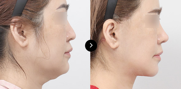 頸部提升 이미지 4