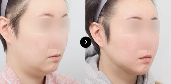 下巴彈力帶提升 이미지 2