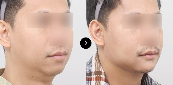 下巴彈力帶提升 이미지 3