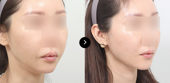 下巴彈力帶提升 이미지 4