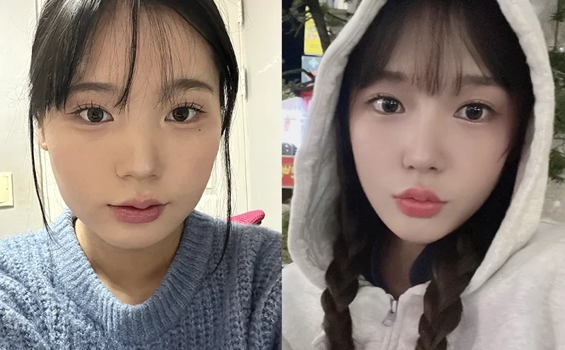 Before and after facial contouring case 1