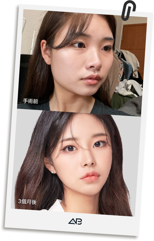 AB Facial Contouring real patient before and after